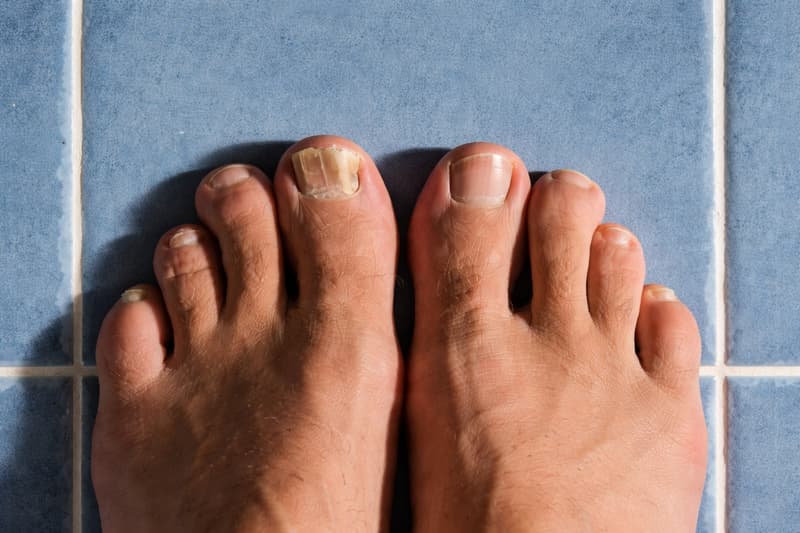 Nagelsvamp bilder - Så ser nagelsvamp ut