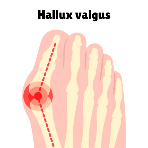 Tåspridare - 2 st - Skydd för hallux valgus, Large (Skostorlek 40-45)